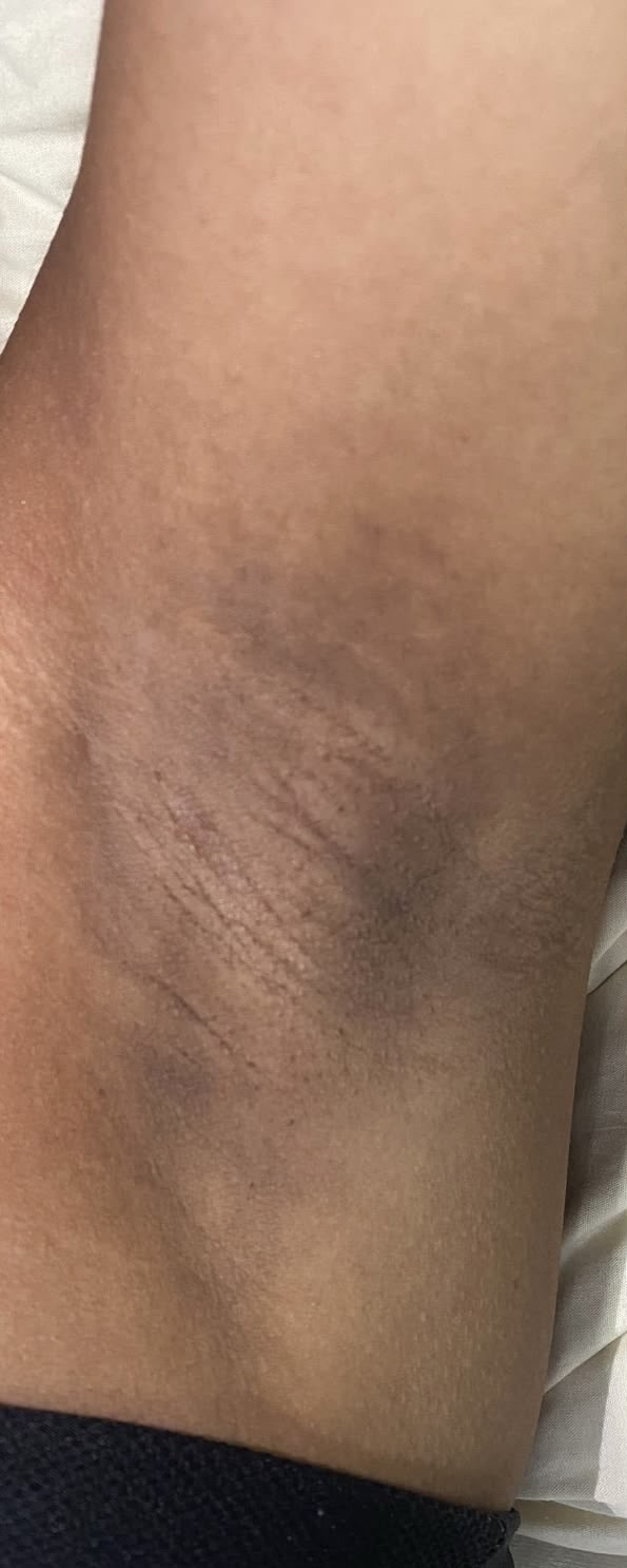 Pele com tatuagem clareada antes da depilação a laser