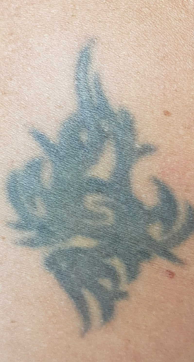 Tatuagem na pele antes da remoção a laser
