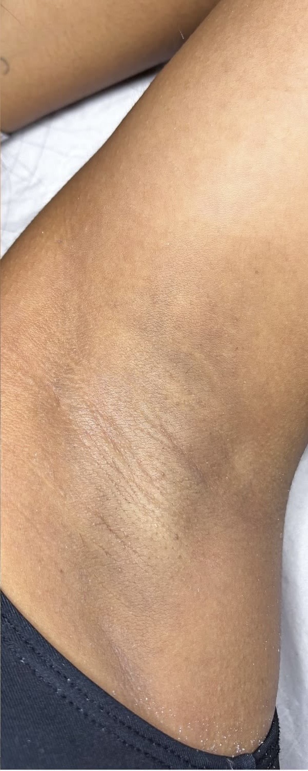 Pele limpa e lisa após sessões de depilação a laser na axila